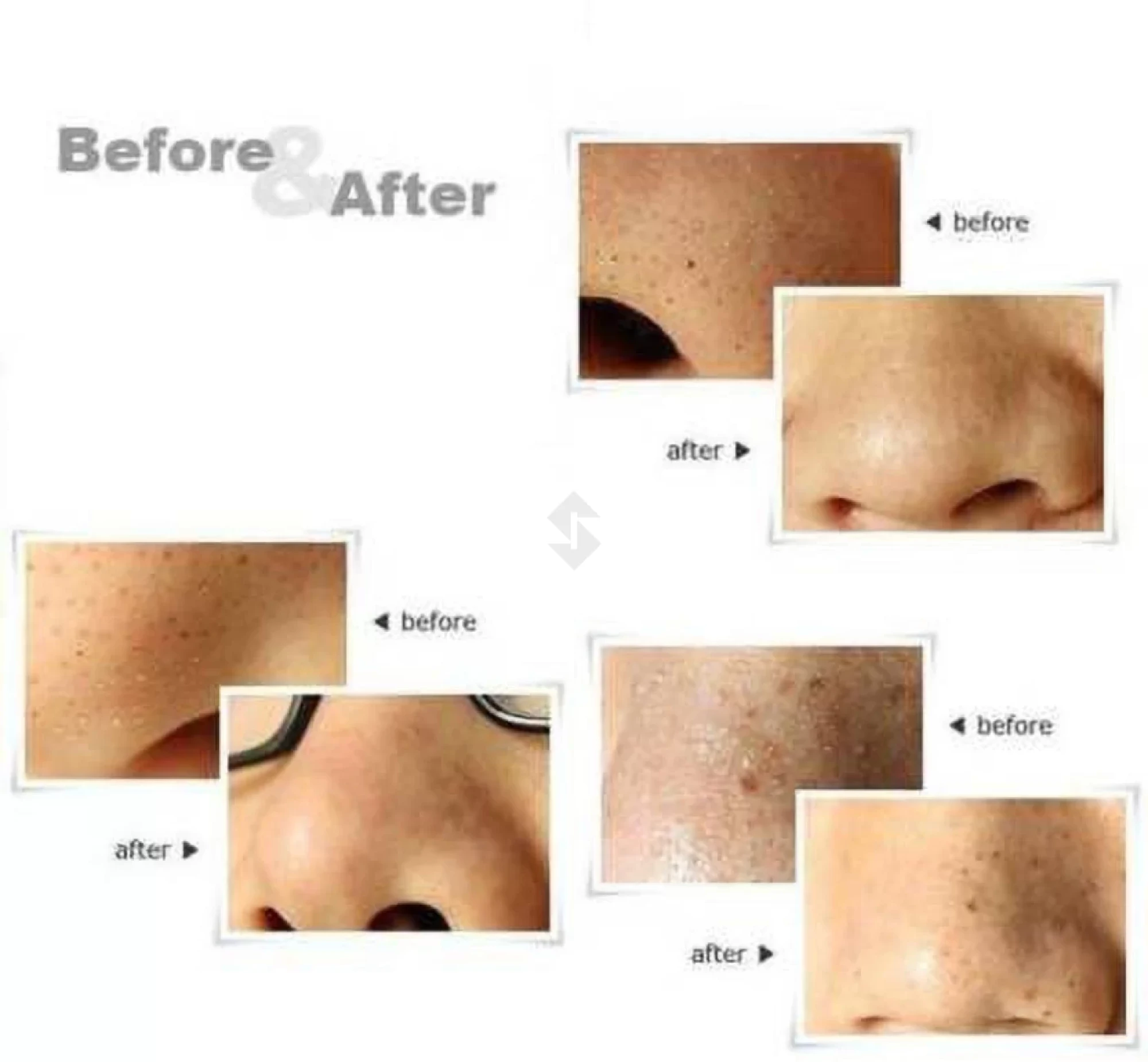 Brother Blackhead Remover Pack of 2.2.webp